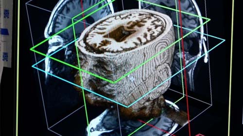 O sistema de inteligência artificial que pode diagnosticar demência em um dia