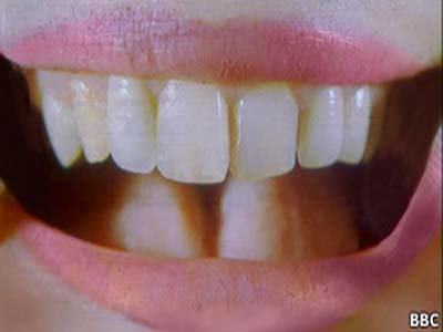 Óleo de coco ajuda a combater queda de dentes, diz pesquisa