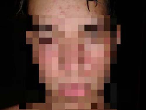 Infectologista alerta sobre incidência de doenças virais, como a catapora, no verão