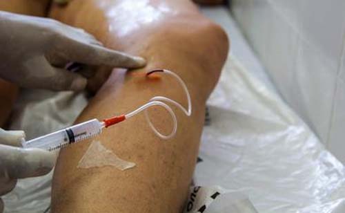 Doença venosa crônica é fator de risco para problemas cardiovasculares