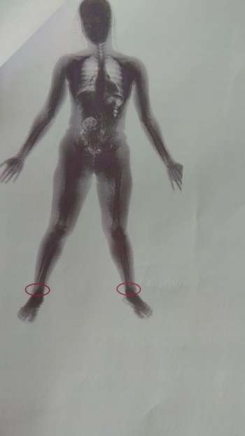 Mulher é flagrada tentando entrar no Presídio do Agreste com droga escondida em calça