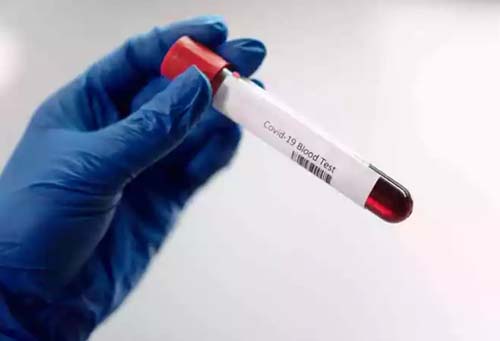 Pesquisadores da Vital Brazil e UFRJ testam soro para tratar covid-19