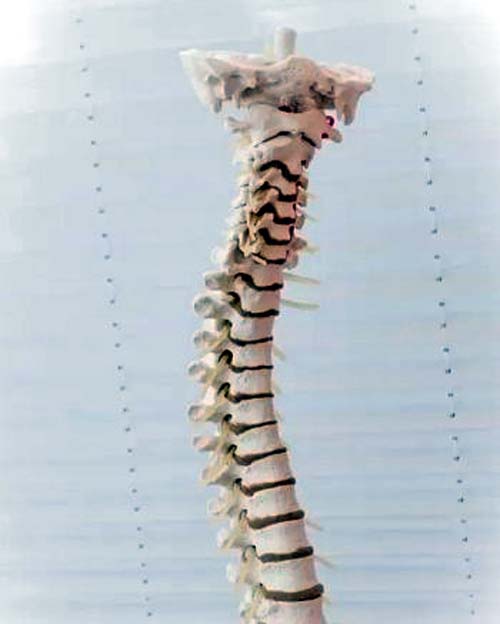 Volta às aulas: Médico alerta para a importância do diagnóstico precoce da escoliose