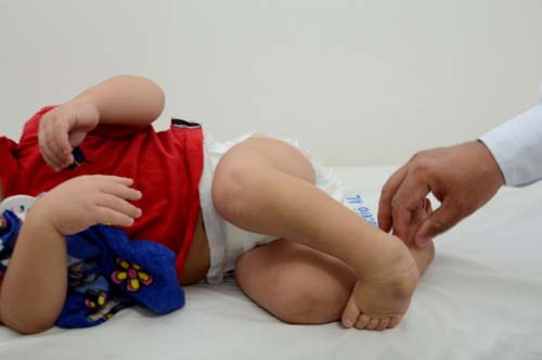 Mutirão de triagem para identificação de pacientes com “Pé Torto” beneficia Agreste e Sertão