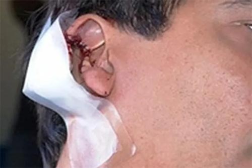 Ex-deputado deve indenizar ex-vereador que teve orelha arrancada durante briga, decide Justiça de Alagoas