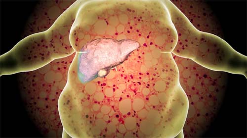 'Inimigo silencioso'. O sintoma que muitos desvalorizam e não deviam do fígado gordo