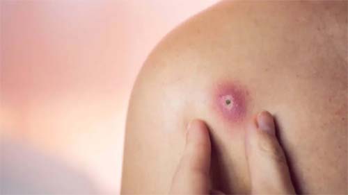 Furúnculo pode ser fatal: dermatologista alerta sobre riscos de automedicação
