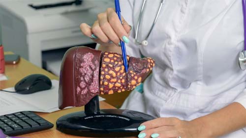 Esteatose hepática: saiba como evitar o acúmulo de gordura no fígado