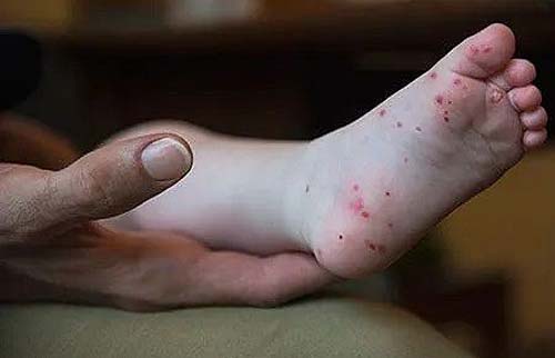 Saiba o que é “gripe do tomate”, vírus que tem afetado crianças na Índia