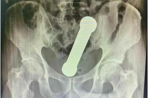 Médicos removem haltere de 2kg do ânus de homem em Manaus;