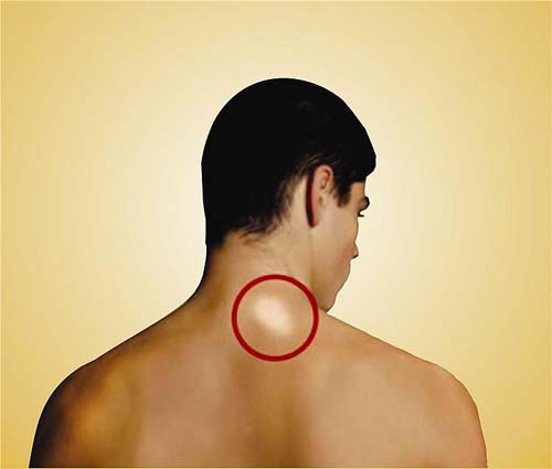 Em Alagoas, 334 novos casos de hanseníase ocorreram em 2018