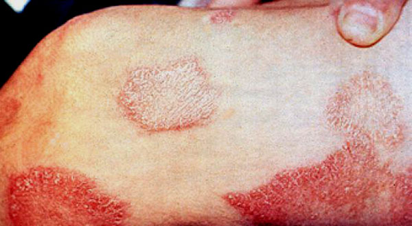 Hanseníase tem cura, mas número de casos da doença no Brasil ainda é alto