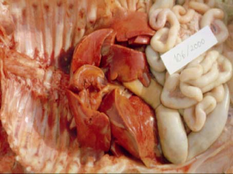 Casos de hepatites diminuem no País, mas óbitos sobem 4,7%