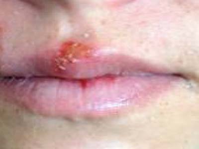 Anvisa suspende importação de remédio contra o vírus do herpes