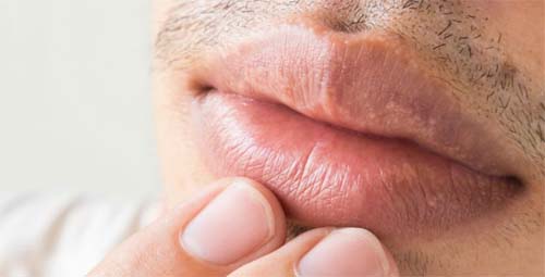É possível transmitir o herpes mesmo sem a presença de feridas?