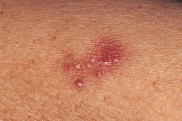 Estudo alerta para a falta de informação das pessoas com herpes 