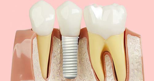 Pessoas com implantes dentários doentes podem fazer tratamento na USP