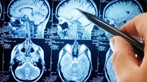 Duas mulheres com paralisia voltam a falar após implantes no cérebro