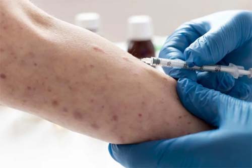 Estudo revela que uma única dose de penicilina pode tratar o estágio inicial da sífilis