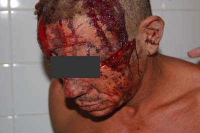 Marechal: Pai tenta salvar filho de briga e acaba levando pedrada