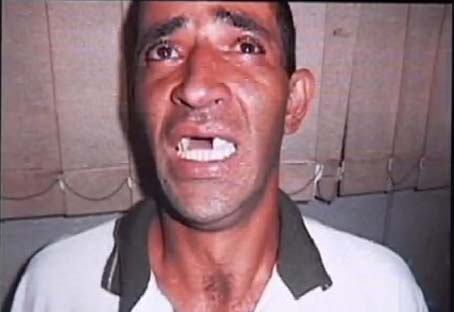 Ladrão esquece dentadura durante roubo e é identificado
