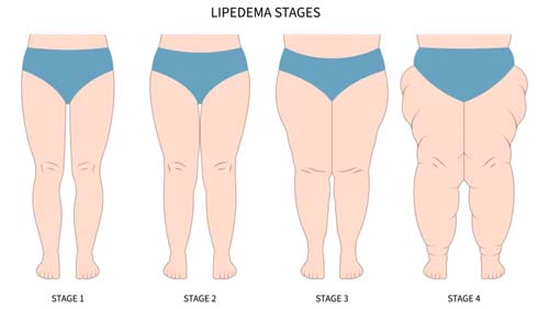 Lipedema: Condição que afeta milhões de brasileiras - É hereditário?