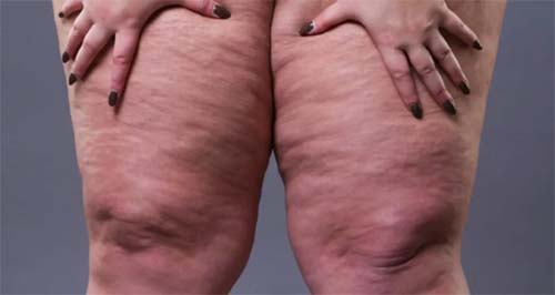 Lipedema a doença que afeta milhões de mulheres no Brasil