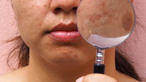 Manchas na pela: saiba o que é o melasma