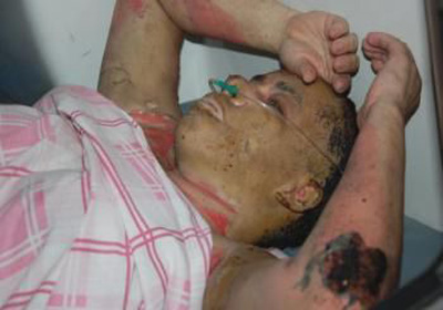 Mulher ateia fogo em seu próprio corpo em Marechal Deodoro