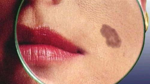 Molécula de bactéria marinha pode trazer avanço para tratar melanoma