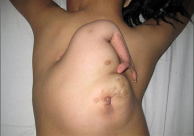 Menina de 11 anos tem terceiro braço nas costas