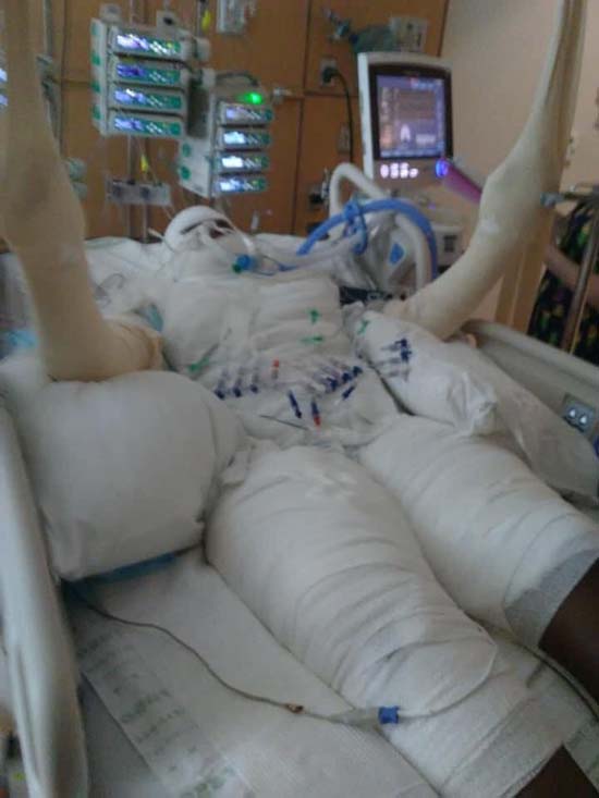 Garota de 12 anos sofre queimaduras graves no 'desafio do fogo'