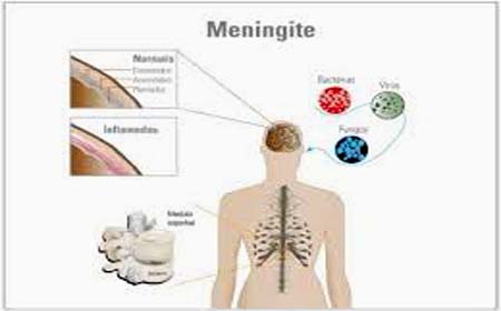 União registra 2 casos; Alagoas tem 113 casos confirmados de meningite este ano