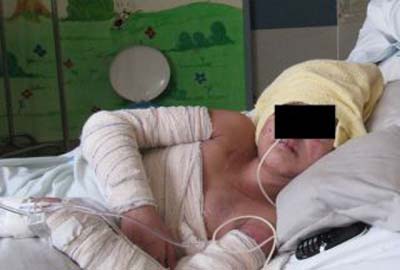 Menino de 11 anos é o 1º paciente de AL a receber implante de pele artificial 