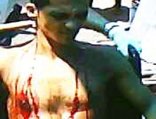 Morador de rua pede socorro com faca cravada no pescoço 