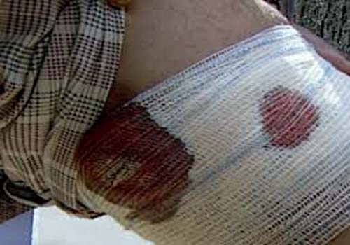 Líder de acampamento dos Sem-Terra sofre atentado à bala na zona rural de União dos Palmares