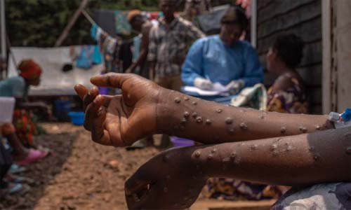 Mais de 1,5 mil casos de Mpox foram registrados no Brasil em 2024