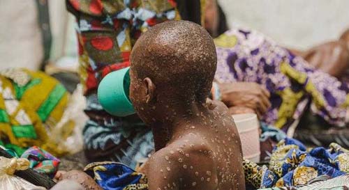 Casos de mpox já chegaram a 60 países