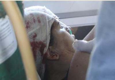 Após agressão com capacete, mulher tem o rosto queimado em escape de moto