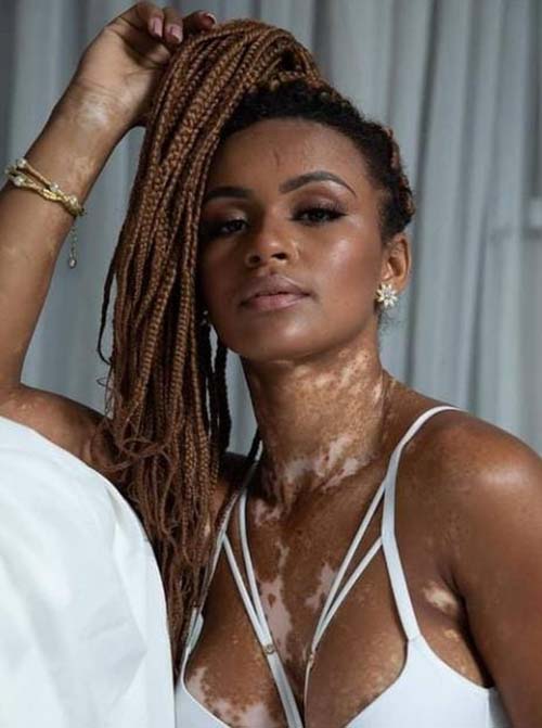 Vitiligo: entenda a doença de pele não contagiosa que afeta 1% da população mundial