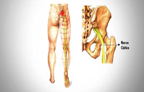 Dor no nervo ciático é sintoma de hérnia de disco em 90% dos casos