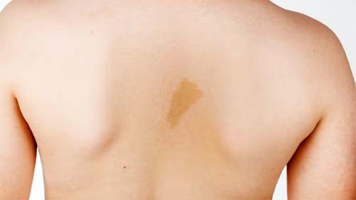 Neurofibromatose tipo 1: diagnóstico precoce é fundamental para garantir a qualidade de vida