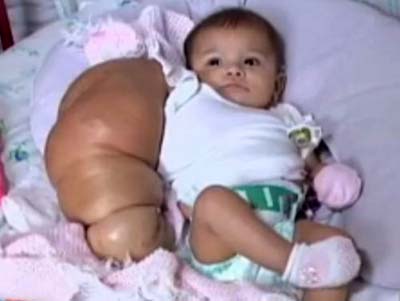 Bebê com braço gigante: pré-natal prevê risco para mãe e criança