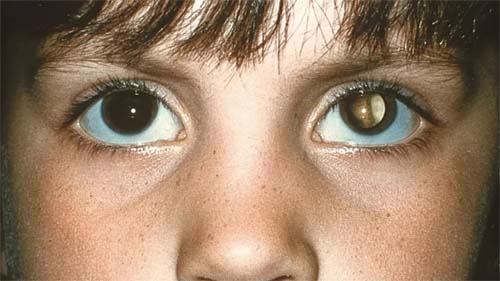 Sinais de alerta em crianças podem indicar retinoblastoma, um câncer ocular potencialmente grave