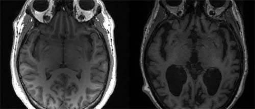 Achado brasileiro abre caminho para remédios capazes de evitar o Alzheimer