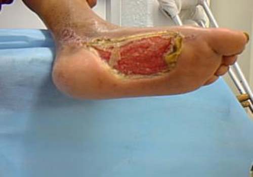 Especialista alerta sobre cuidados com o pé diabético