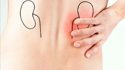 Médicos alertam para alta incidência de pedras nos rins no verão