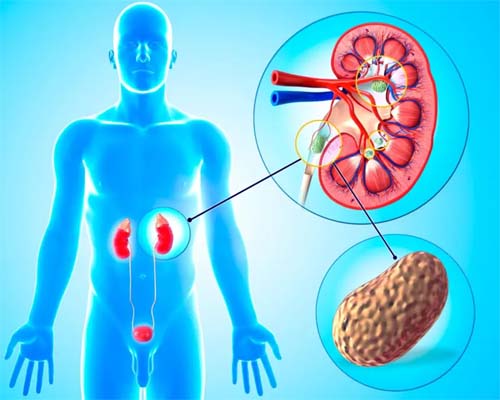 Cálculo nos rins e na garganta: quais pedras nosso corpo produz e como podemos evitá-las