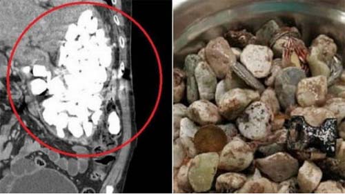 Médicos retiram 2 quilos de pedras, moedas e tampas do estômago de paciente