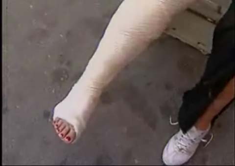 Após discussão, pré-candidato a vereador quebra perna de eleitor em Canapi